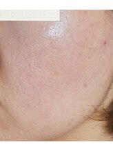 サロンドカイ(Salon de Kai)/肌育成プログラム　4年目