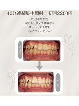 プラスビーセルフ(+b self)/ホワイトニングビフォーアフター
