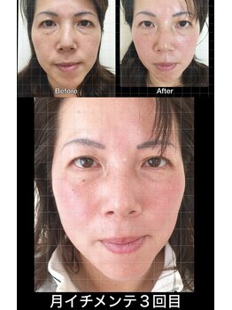 まこと鍼灸院/美容鍼の効果 月1メンテナンス