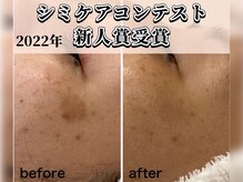 トリニエンス 南流山店/30代/シミケア