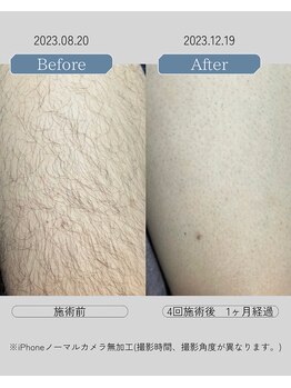 ジールクス 太田店(G LUX)/足(太もも)