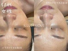 ミコサロン(miko salon)/ホワイトニングピーリング