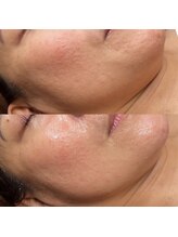 セレン(Seren)/たるみ・ゴワゴワ肌には筋膜ケア