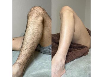 エル ブランシュ(Ailes blanches)/メンズ脱毛