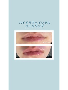 ウルト アルティメイトスキン(ULT ultimate skin)/パークリップ