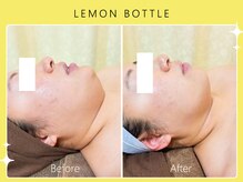 ハノハノ 八代店(HANO HANO)/小顔コルギ×レモンボトル☆