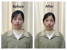 まごころ整骨院の雰囲気（美容鍼＋小顔矯正before＆after（１回施術））