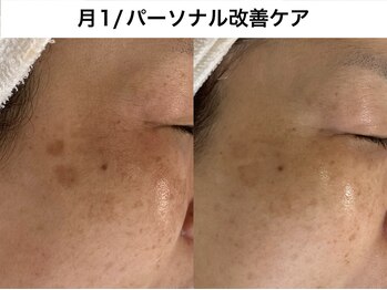 トリニエンス 南流山店/50代/シミケア/パーソナルケア