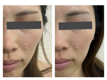 ザ ワン(THE ONE)/美禅筋骨小顔×ヒト幹細胞導入