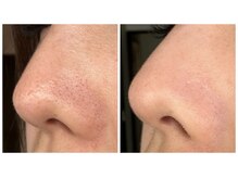 リラ(RILA)/肌育毛穴洗浄before after