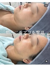 リメイク 銀座(REMAKE)/リフトアップ小顔フル工程