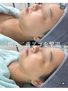 リメイク 銀座(REMAKE)/リフトアップ小顔フル工程