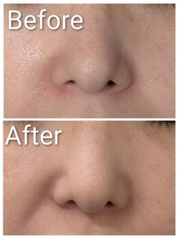 ミヨン ヨコハマ(Miyonne Yokohama)/LDM Aqua+小顔ヘッドスパ上大岡