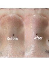 ラトゥール(Latour)/毛穴フェイシャル