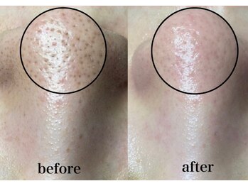 毛穴専科/韓国肌管理◇ 学割u24あり