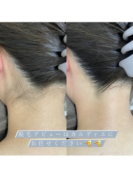 カルディエ(Cardie)/うなじ脱毛　ビフォーアフター