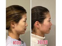 小顔22 ボルティ 赤坂支店(Bolty)/【面長の悩み】解消サロン