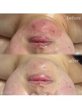 スピカ(Spica)/肌悩みに合わせてご提案!