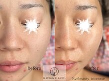 アイ ビューティー インクリース 岸和田店(Eye beauty increase)/プラチナピーリング