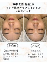 シーフェイス 横浜店(SEE FACE)/ラジオ波小顔コルギフェイシャル