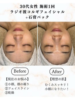 シーフェイス 横浜店(SEE FACE)/ラジオ波小顔コルギフェイシャル