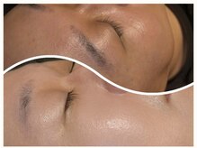 プラピール＝シミ、しわ、毛穴、ハリ弾力、角質改善に効果的！