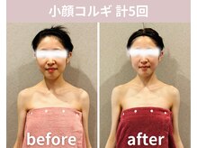 フェリシア(Felicia)/【小顔コルギ】計5回の結果