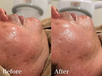 シャルム(Charme)/メンズフェイシャル♪たるみケア