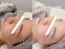 ルノン(Lunon)/【浮腫くすみ】小顔フェイシャル