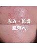 人気No1!【敏感/乾燥/赤み】集中保水ケアでゆらぎ改善♪