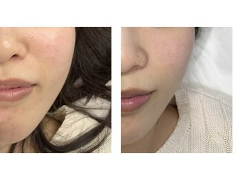 ロカヒ(Lokahi)/光フェイシャル