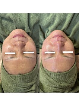 リテラ(Retera)/Wax脱毛