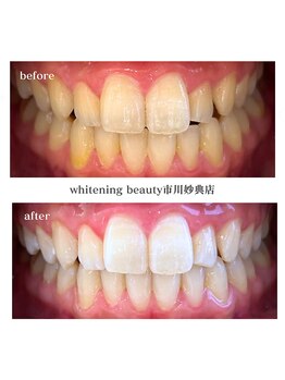 ホワイトニングビューティー 市川妙典店/頑固な根元の黄ばみも取り除く