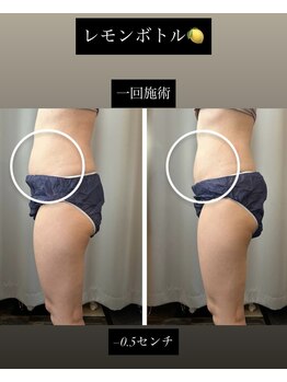 チャルム(CAL'ME)/レモンボトル・下腹