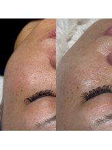 オフモード(OffMode)/毛穴洗浄とソフトダーマW攻め！