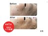 New!!再生美容×高浸透エクソソーム導入フェイシャル/敏感肌可