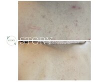 ストーリー 岐阜店(STORY)/ハーブピーリング専門店STORY