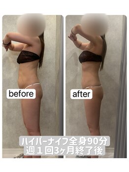 レイ(Ray)の写真/憧れのサイズダウンをサポート!ハイパーナイフで身体の中から温まり、至福の気持ちよさを堪能しませんか?