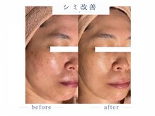 シャルナ(charna)の雰囲気（シミ改善症例）