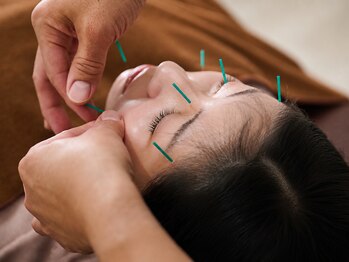 明るき鍼灸院・接骨院の写真/【眼精疲労緩和と美しさを叶える!】自律神経不調/不眠/クマの改善/エラ張りに◎美容鍼で目に見える効果を♪