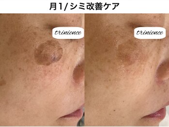 トリニエンス 南流山店/40代/シミケア/肌代謝促進