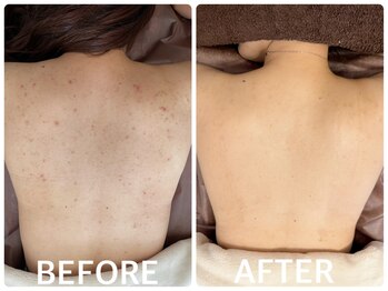 ハーブピーリング 恵比寿/ハーブピーリング背中ニキビケア