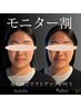【期間限定 症例モニター&口コミ投稿】小顔リフト美容鍼¥3,980→¥980