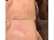 美容整骨小顔ラボ/肌【複合施術】ビフォーアフター