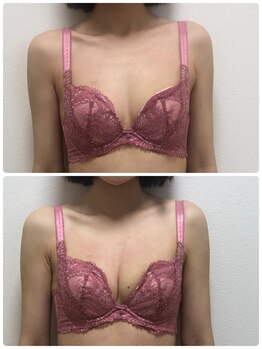 アンドモア(&more)/バストアップ症例