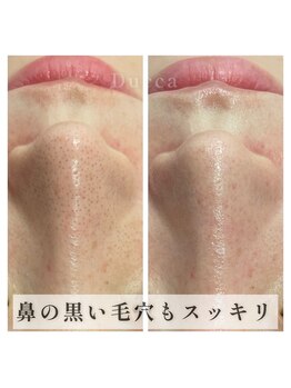 デュッカ 箕面(Ducca)/毛穴洗浄／ツルッとタマゴ肌に！