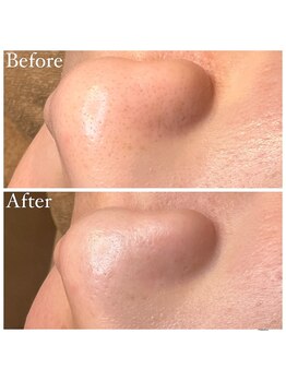 マドモアゼル 麻布十番/毛穴洗浄