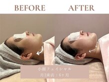 サエラ(SAERA)/小顔ケア【6回】