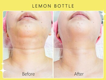 ハノハノ 八代店(HANO HANO)/【八代初導入！】レモンボトル☆