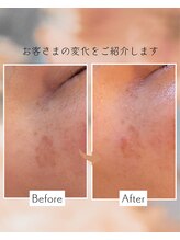ナオフクオカ ヒーリングフォースエヌ(NaoFukuoka/healingforceN)/20年来のシミが薄く変化！